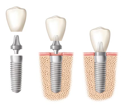 Dental Implants - El Paso, TX - The Dentist