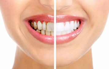 Bright Smiles Ahead: The Ultimate Guide to Teeth Whitening in El Paso