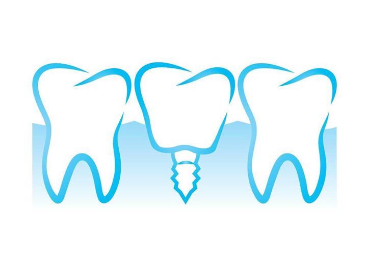 Tips for Caring for Your New Dental Implant in El Paso, TX