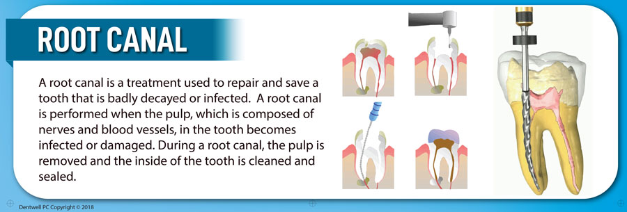 Root Canal Therapy - The Dentist -El Paso, TX Dental Office - Avoid a tooth extraction!