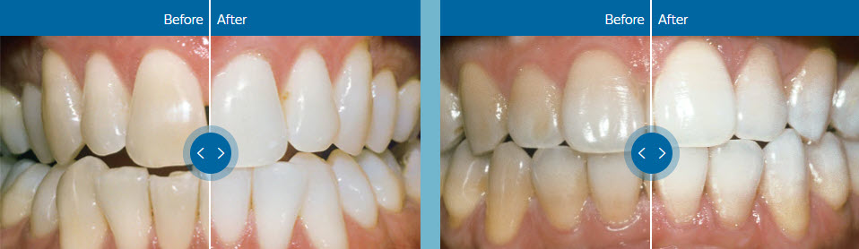 Teeth Whitening - The Dentist El Paso - Professional In-Office Whitening