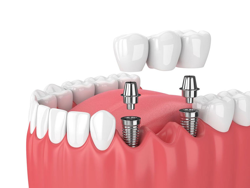 By anchoring directly into the jawbone, dental implants provide a stable, permanent foundation for individual crowns, bridges, or full dentures while preserving your facial structure.